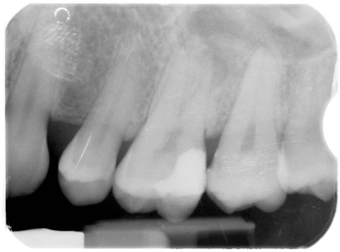 Upper molar root canal case